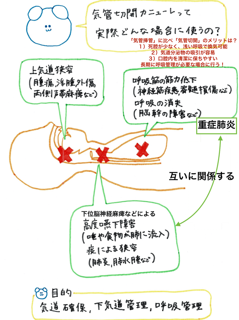 気管切開の適応〜やゆさんのイラストで解説〜　記事と連動しています