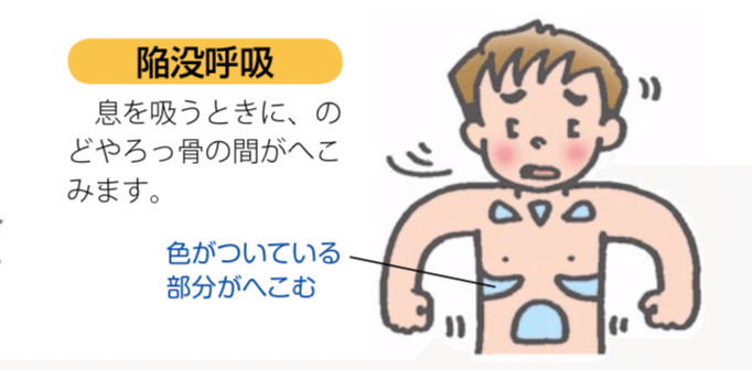 ぜん息発作の時はどのような症状になりますか Dr モッシー Note