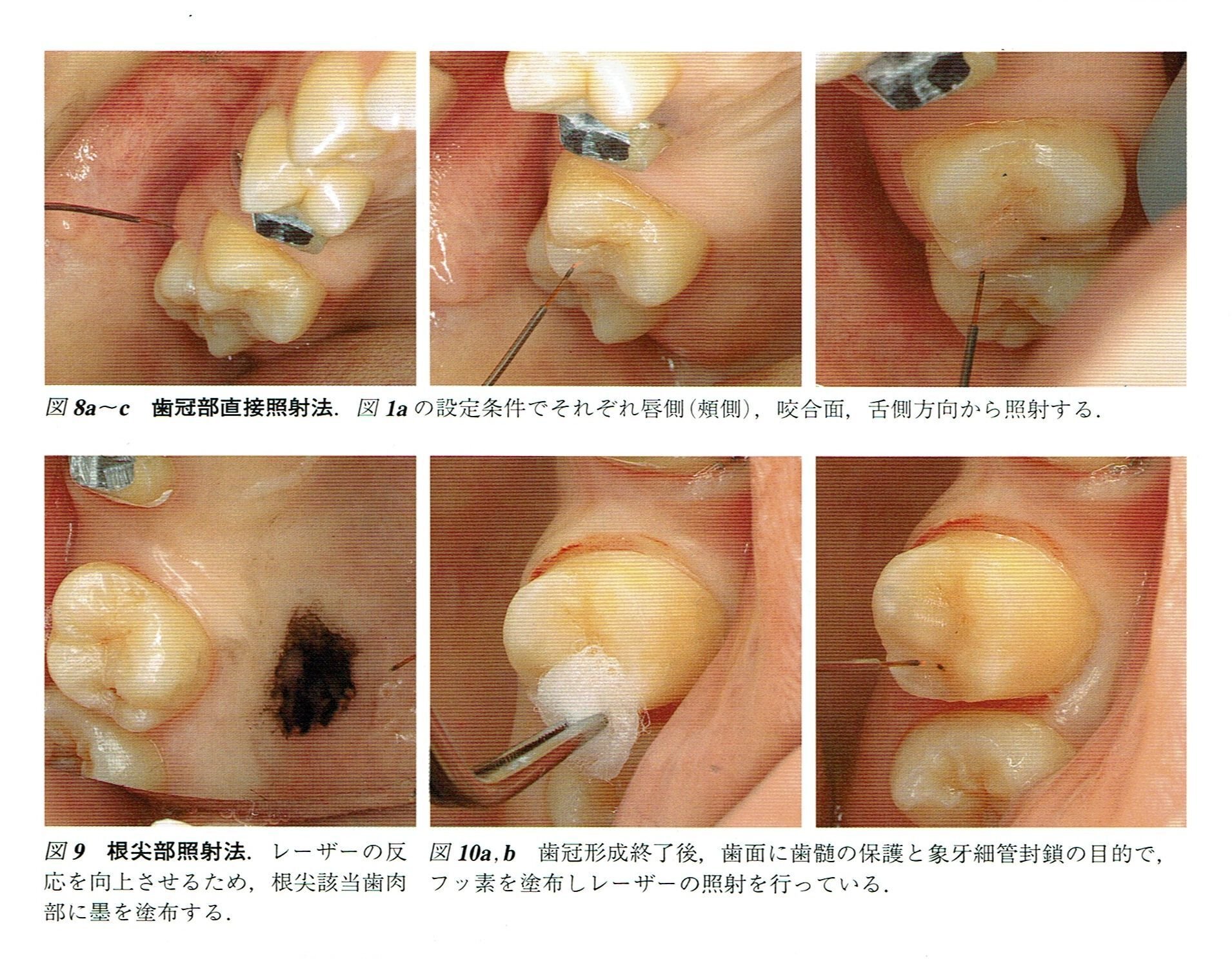 Minimal Interventionの観点から歯科のう蝕治療に欠かせないAir