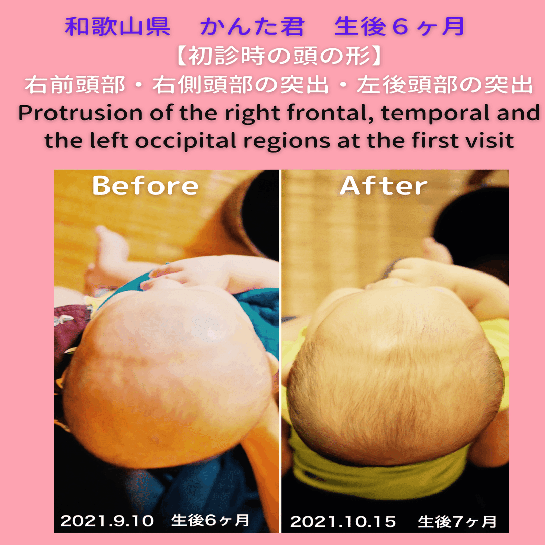 赤ちゃんの斜頭症 向き癖の改善例をご紹介 生後６ヶ月の頭の形がこうなりました 小松広明 Note