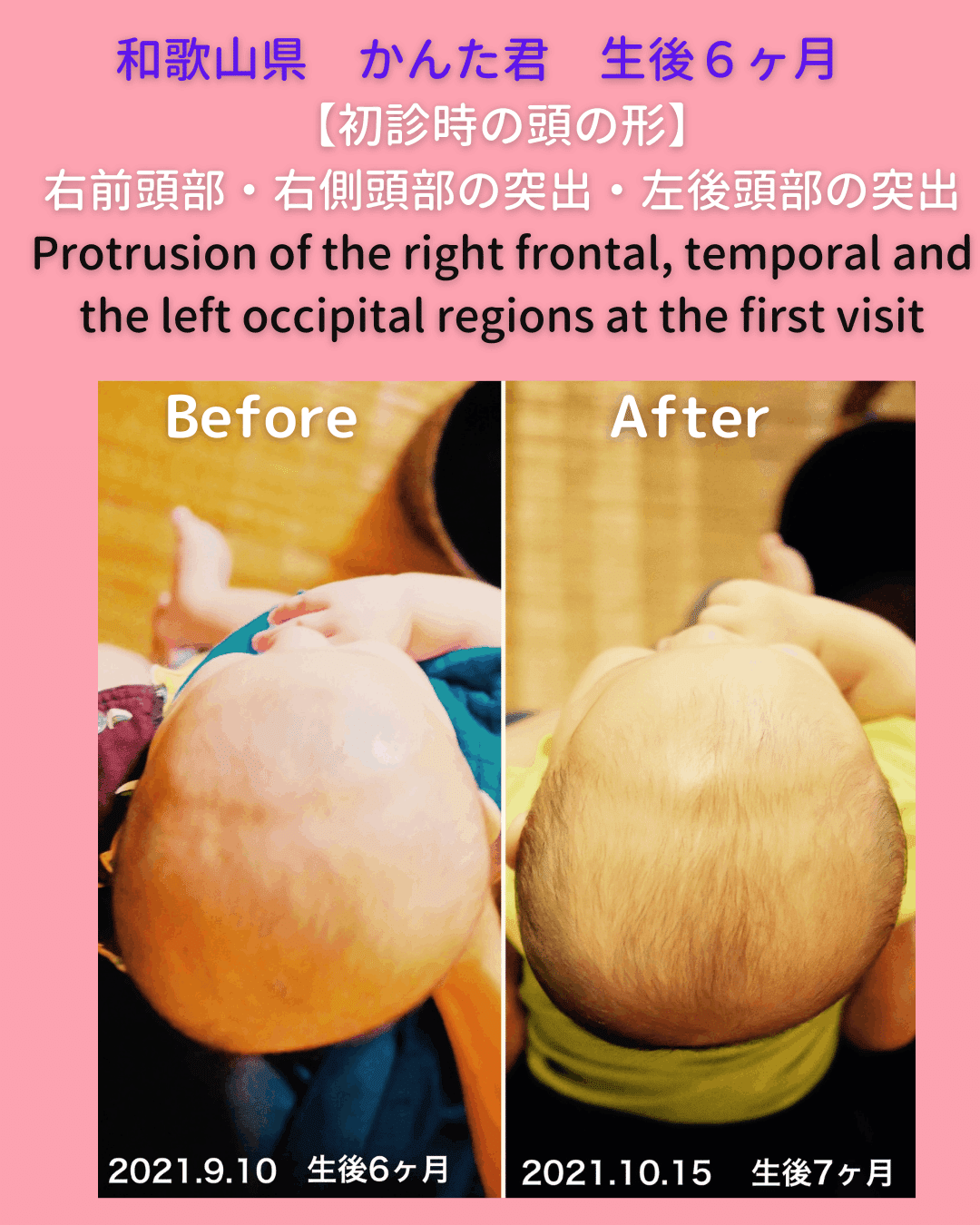 赤ちゃんの斜頭症 向き癖の改善例をご紹介 生後6ヶ月の頭の形がこうなりました 小松広明 Note 赤ちゃんの斜頭症 向き癖の改善例をご紹介 生後6ヶ月の頭の形がこうなりました 小松広明 Note