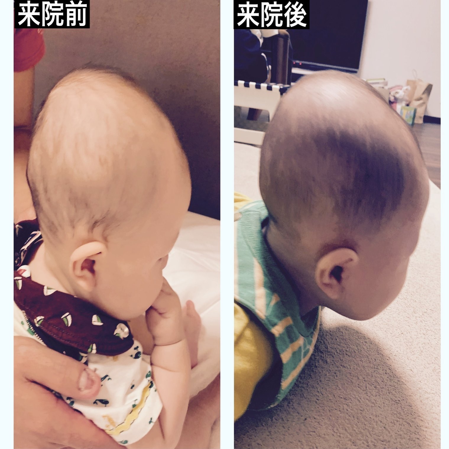 赤ちゃんの斜頭症 向き癖の改善例をご紹介 生後６ヶ月の頭の形がこうなりました 小松広明 Note