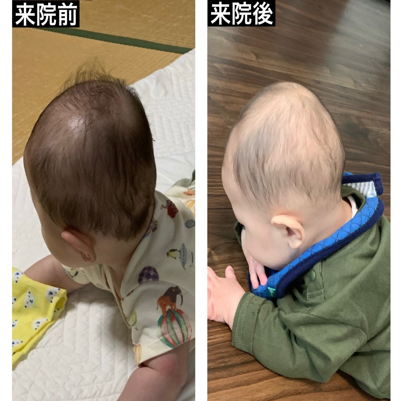 赤ちゃんの斜頭症 向き癖の改善例をご紹介 生後６ヶ月の頭の形がこうなりました 小松広明 Note
