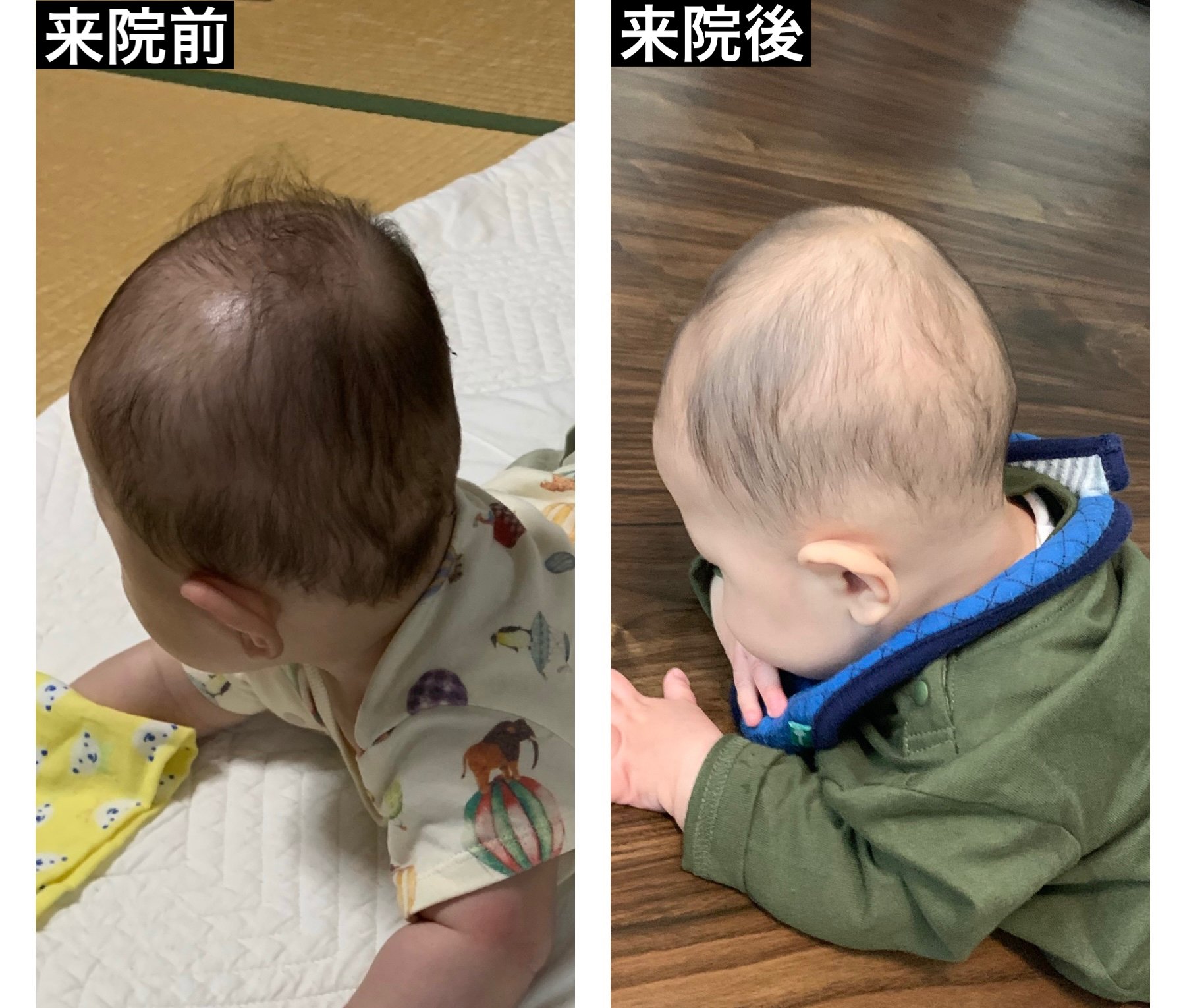 赤ちゃんの斜頭症 向き癖の改善例をご紹介 生後6ヶ月の頭の形がこうなりました 小松広明 Note 赤ちゃんの斜頭症 向き癖の改善例をご紹介 生後6ヶ月の頭の形がこうなりました 小松広明 Note