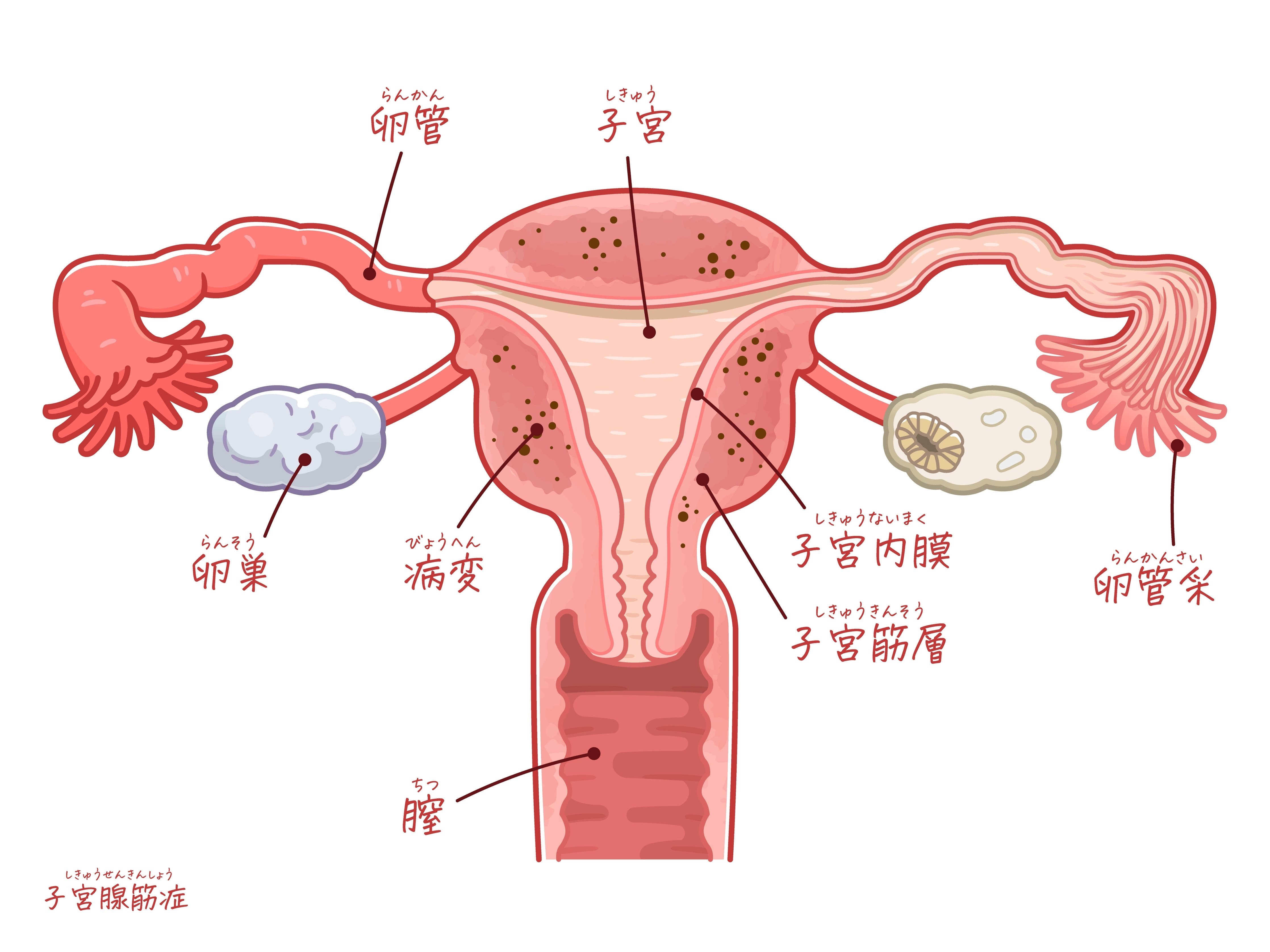 子宮腺筋症と不妊｜おちまさゆき-正しい知識で正しい妊活を-