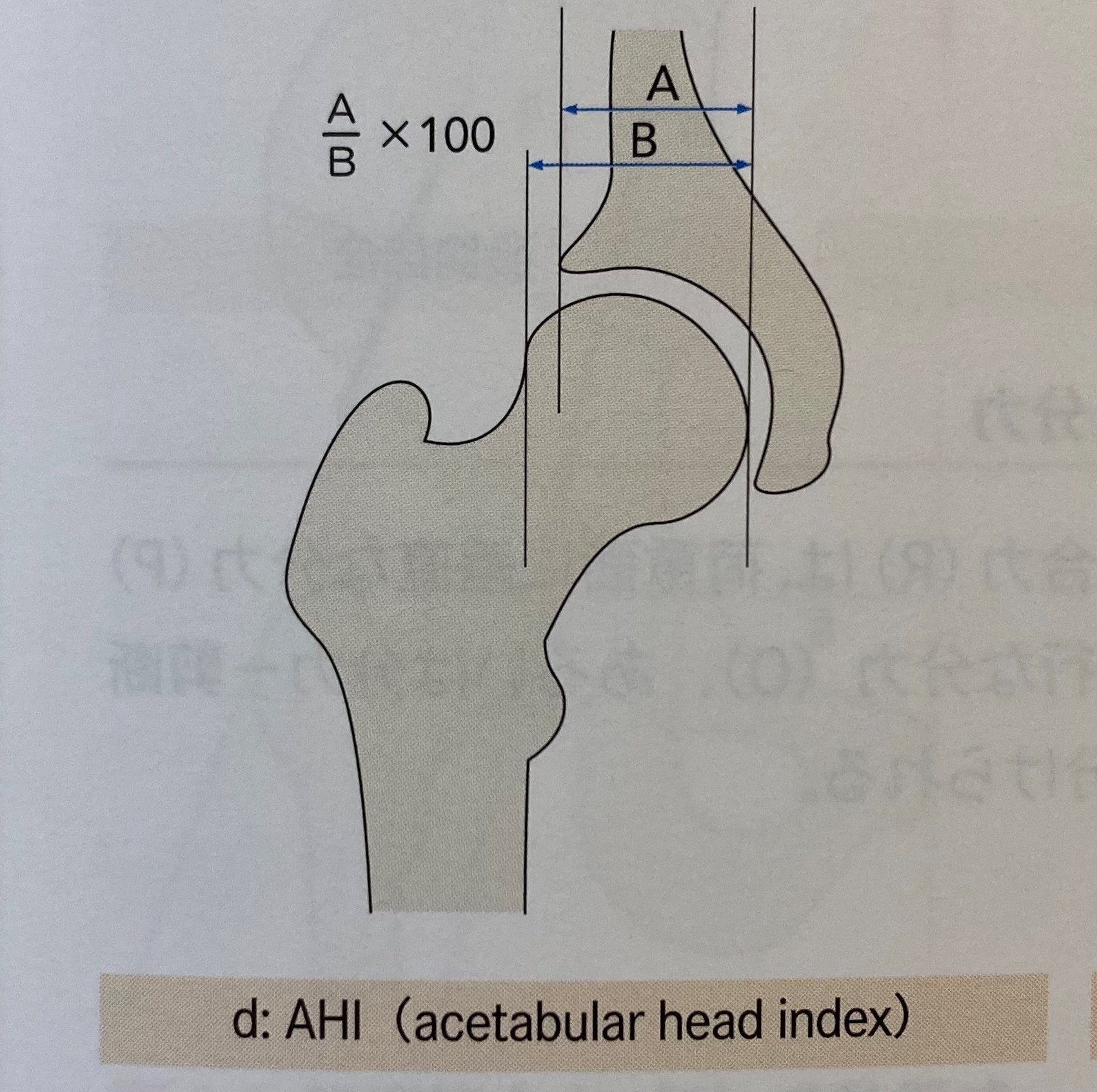 股関節】臼蓋形成不全について｜整形外科リハ｜理学療法士|Tomo