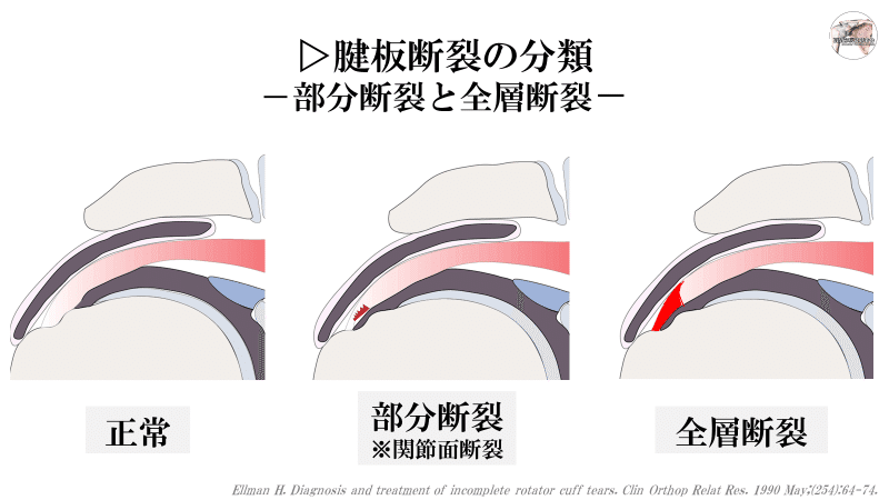 症例から学ぶ肩疾患 part 1: 成書にはない診断・治療のポイント 肩症例検討会 肩こり・五十肩・腱板断裂 肩の痛みがよくなるすごい方法|歌島