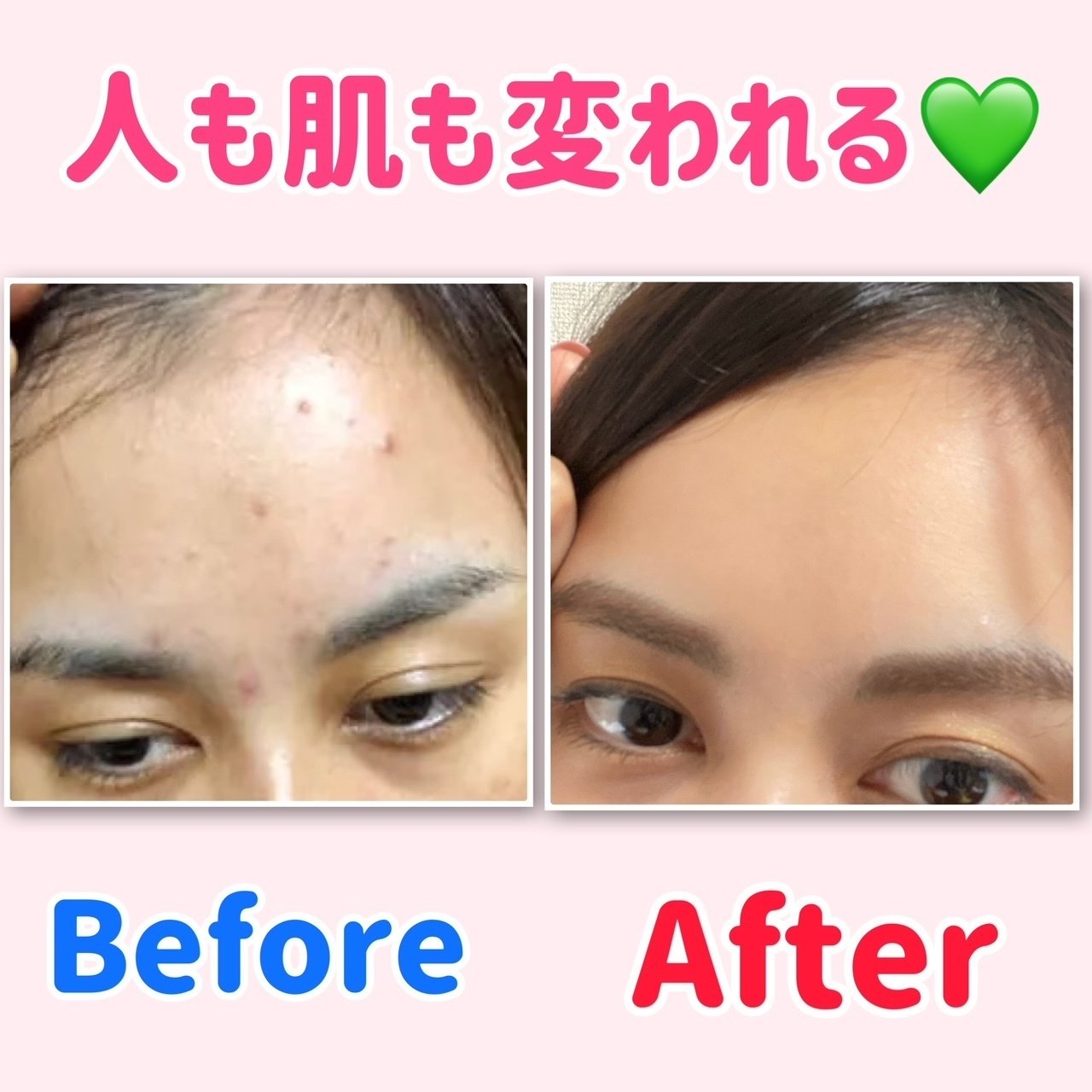 人も肌も変われる 汚肌 美肌になれた理由 野本めぐみ Note 人も肌も変われる 汚肌 美肌になれた理由 野本めぐみ Note