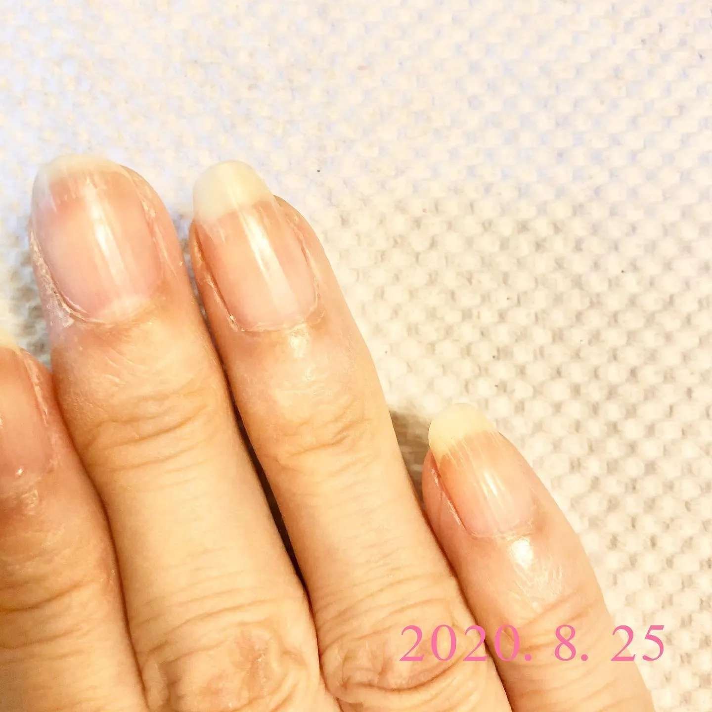 爪甲剥離症の悩み 介護ネイルアカデミー Note