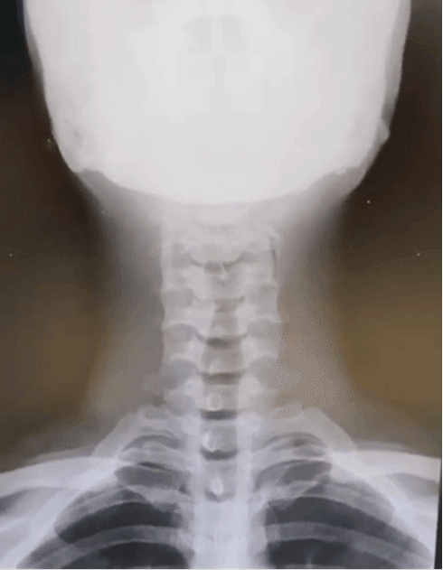 トリセツ】レントゲン撮説～頸椎のレントゲン その1～｜issy