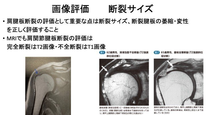 監修:村木孝行先生の肩関節理学療法マネジメント要約PDF|リハビリセミナー|note 監修:村木孝行先生の肩関節理学療法マネジメント要約PDF|リハビリセミナー|note
