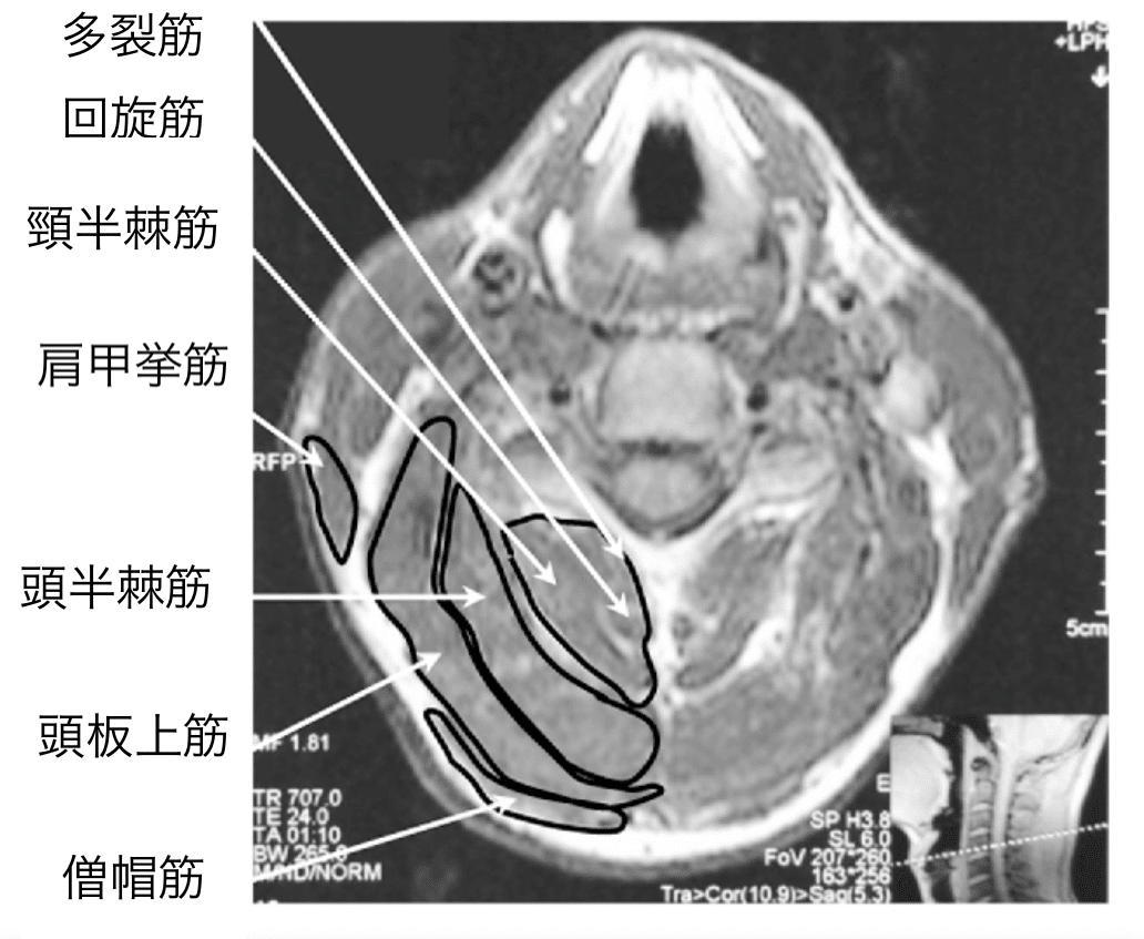 SUE FALSONE 頸胸椎移行部〜解剖学的構造の理解と治療戦略〜 Sue Falsone Cervical Thoracic Junction頸胸椎移行部～解剖学的