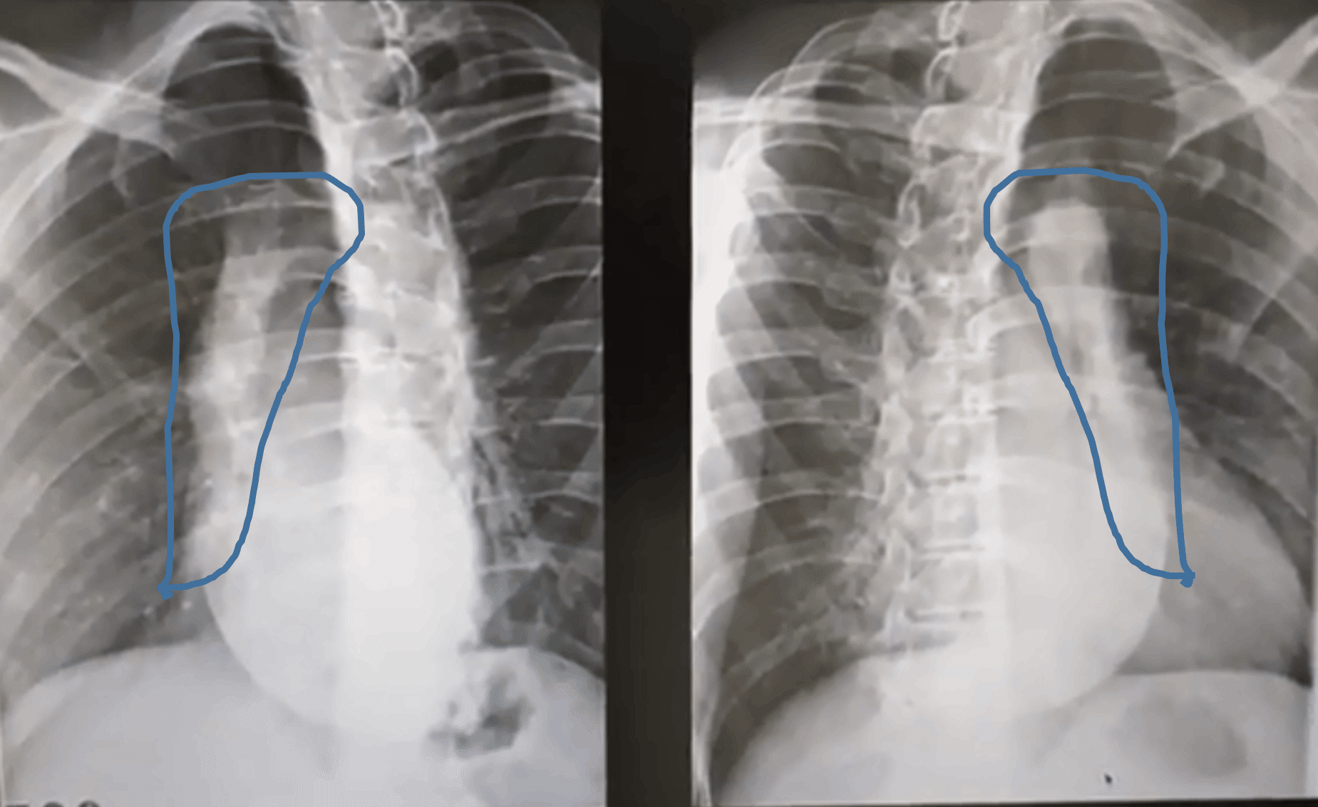 トリセツ】レントゲン撮説～胸骨のレントゲン～｜issy