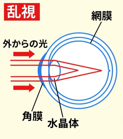 #105 乱視の見え方解説!最適なコンタクトレンズ選びのポイント 【レンズアップル】【コンタクトレンズ】|コンタクト社長★よしだちゃんねる