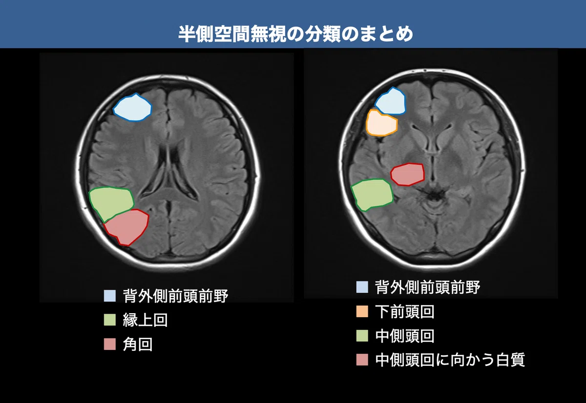 半側空間無視 頭頂葉 | 脳梗塞が起きる部位と症状や特徴を部位ごとに解説 – YWMDQO