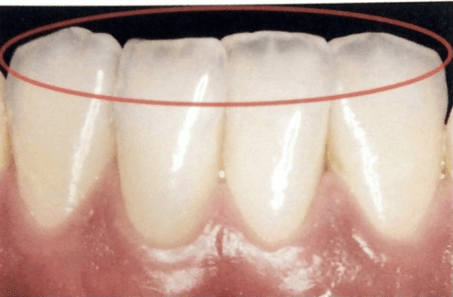 酸蝕歯の画像