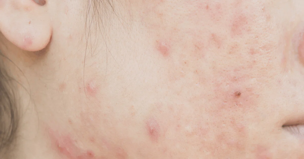 ほっておいて大丈夫?皆さまの顔に生息している「顔ダニ」とは一体!?|メンズスキンケアブランドROGEN【ロージェン】公式