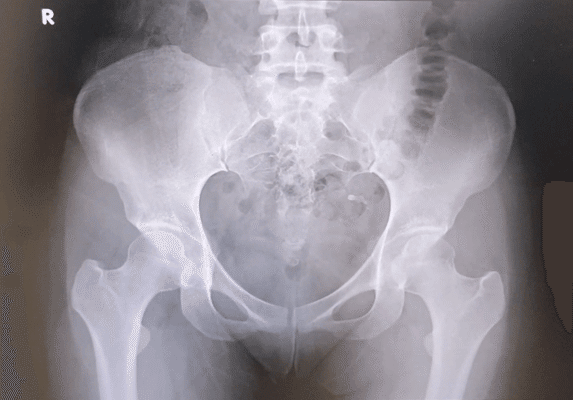 レントゲン写真 X線写真 Z97 エックス線について - 白川病院