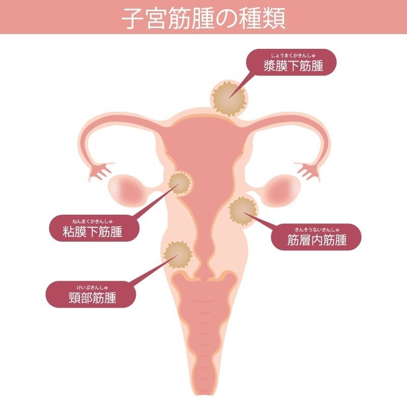 子宮筋腫　種類