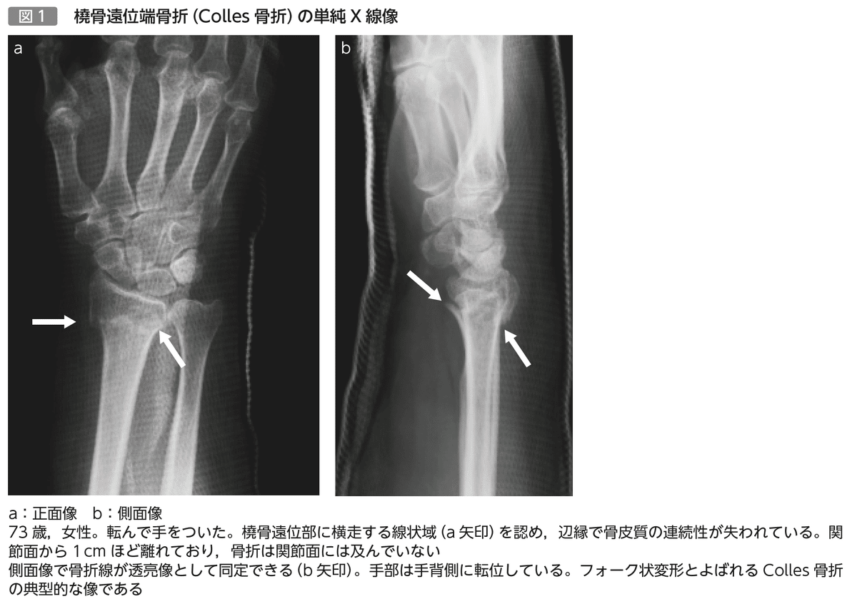 【裁断済み】新版　橈骨遠位端骨折 The Cutting Edge 新版 橈骨遠位端骨折: 進歩と治療法の選択 The Cutting Edge
