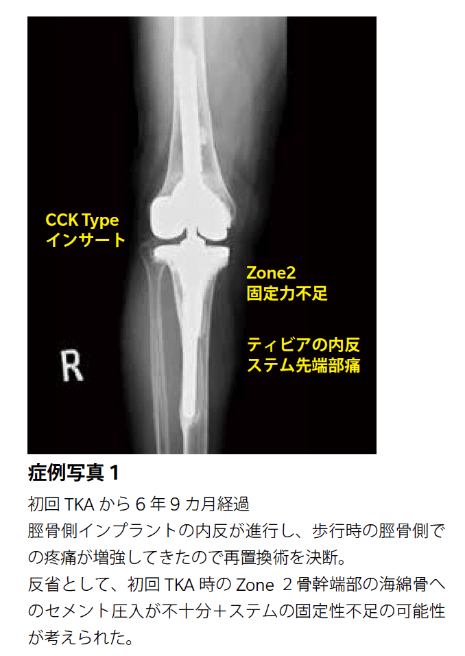 人工膝関節再置換術 Revision TKAの基本手技 確かな機能の再建をめざ… 人工膝關節再置換術 REVISION TKAの基本手技 確かな機能の再建を