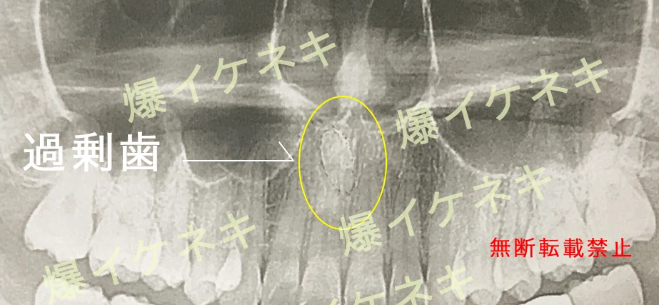 大人の過剰歯抜歯〜入院と費用〜|イケネキ👽痩せて綺麗なお母さんになる