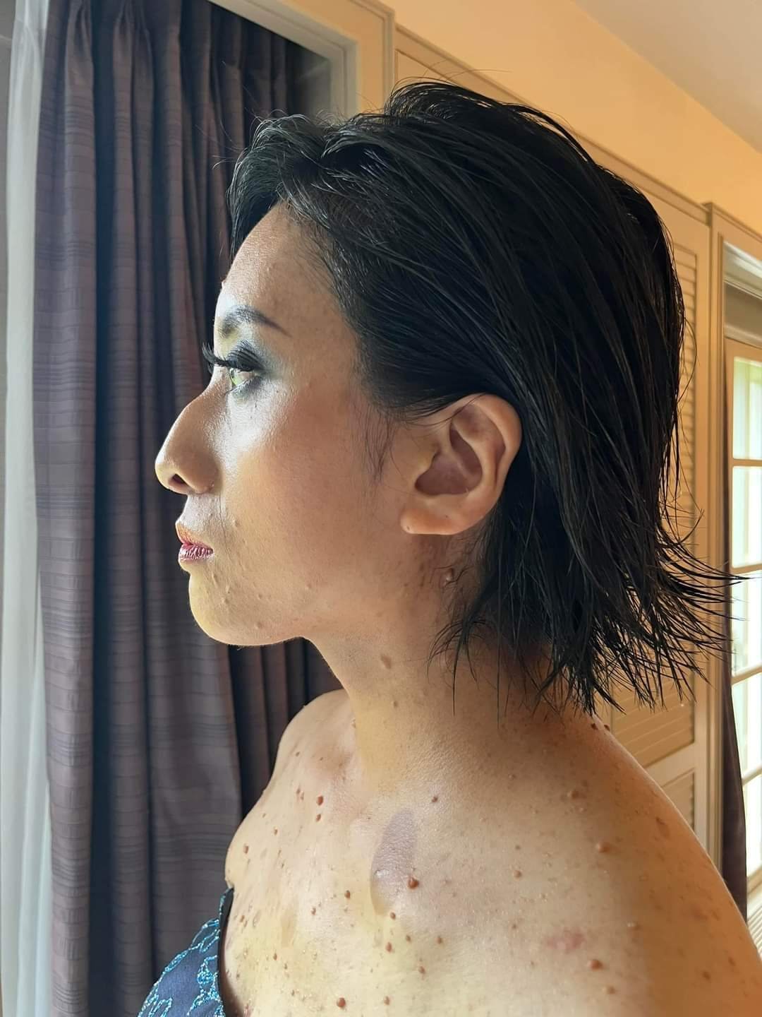 レック リング ハウゼン 病 有名人