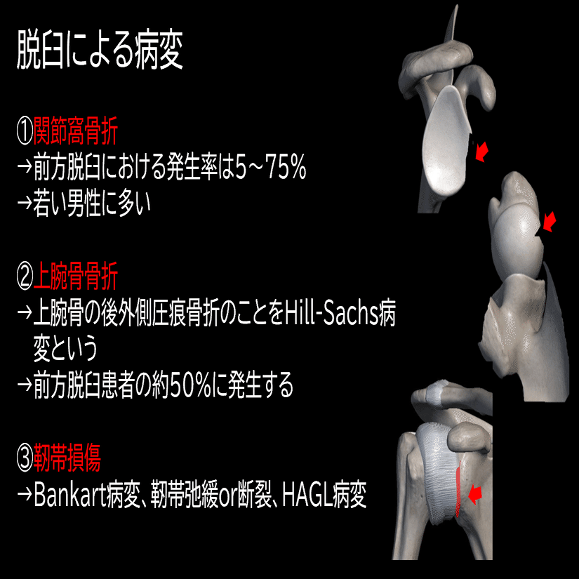 肩関節脱臼と理学療法｜Asumi.Kumada