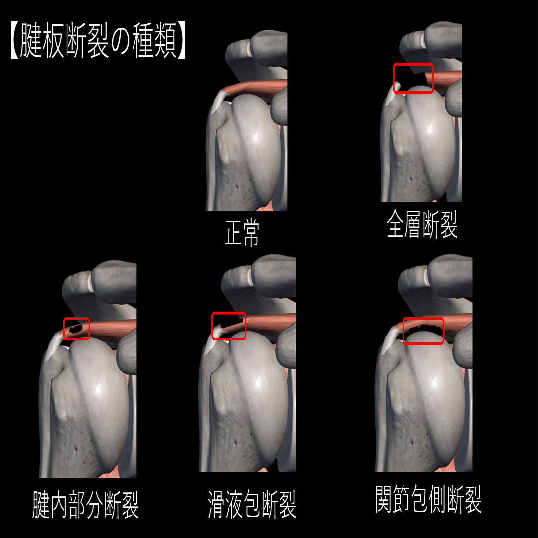 肩関節におけるMRI画像の見かた｜Asumi.Kumada