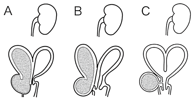 腎機能不全のリスクにさらされているのは誰ですか?