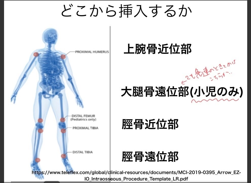 骨髄 骨髄針の使い方（2022/12記事から）｜Zion