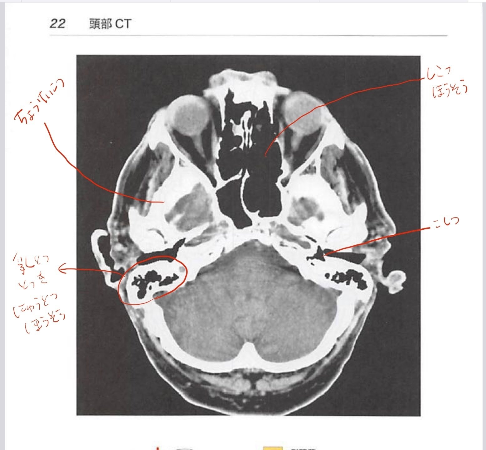 コンパス 顔面骨骨折の治療 ベーシック版　裁断済み コンパス顔面骨骨折の治療 ベーシック編 | 坂本好昭 |本 | 通販