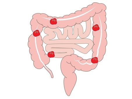 ループ型人工肛門は何に使用されますか?