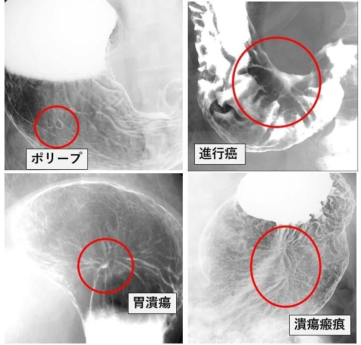 バリウム(胃部X線)検査って?~Fin~|世代-SeDaI-