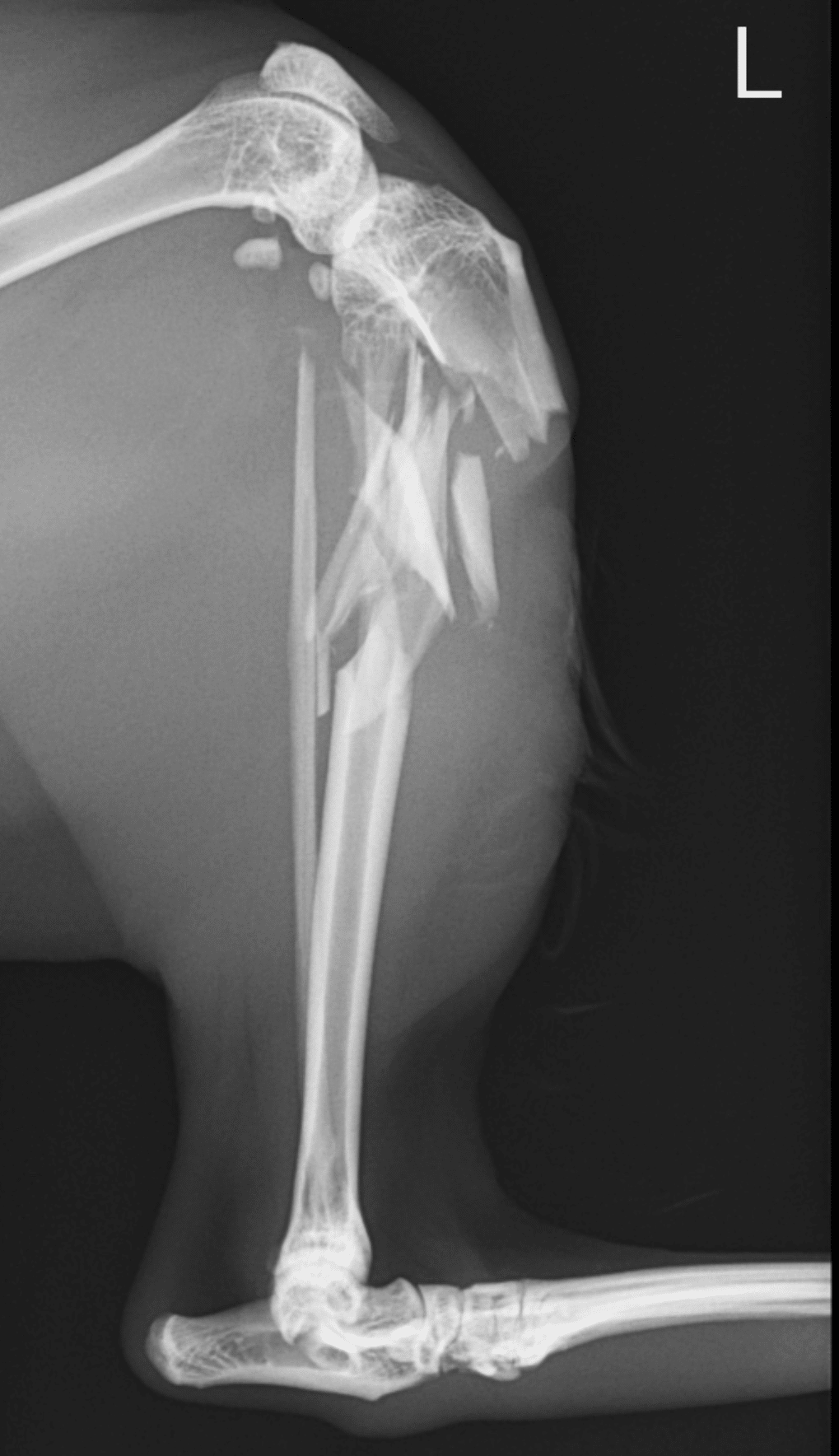 手術note6 脛骨骨幹部粉砕骨折の最少侵襲プレート固定術（MIPO)｜QUARC