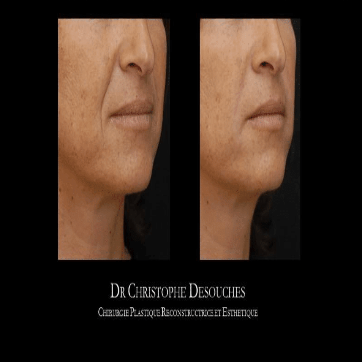 ほうれい線の鼻翼基部・貴族手術について個人的まとめ｜けい/整形垢, image size:2000x1119