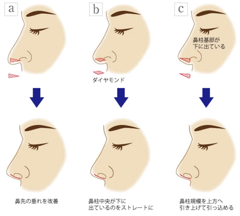 鼻整形④-3:鼻柱の手術|ゴリバラ|note