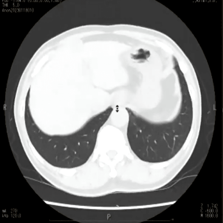第5回ウェブラジエーション勉強会症例提示 □ 胸部単純CTの落とし穴｜issy