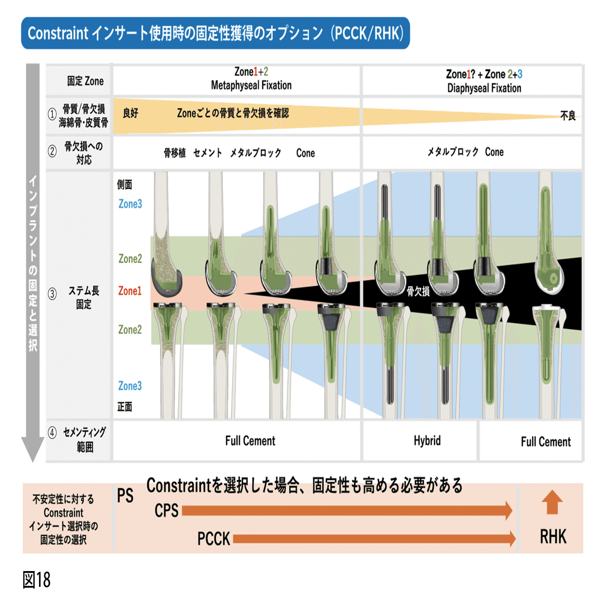 第20回】Complex TKAに対する考え方-7｜メジカルビュー社