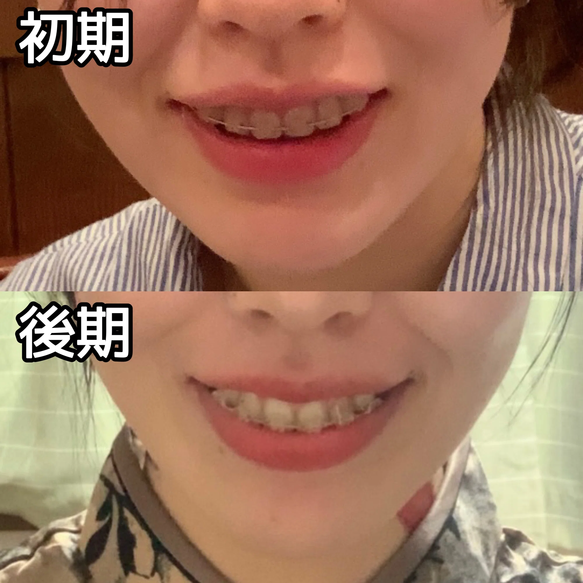歯 列 矯正 老け 顔 写真