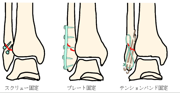 足首骨折からのリハビリ・復帰活動に｜Bauerfeind(バウアーファインド