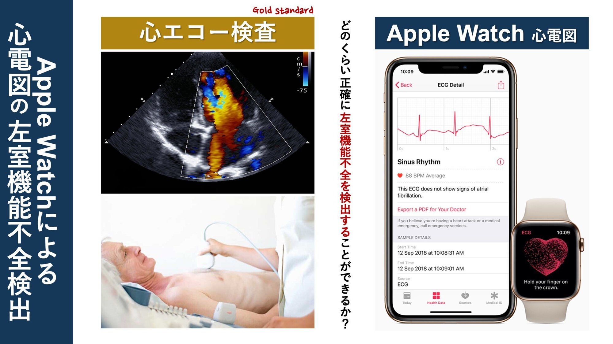 hirakata777’s diary アップルウォッチの心電図による左室機能不全の検出