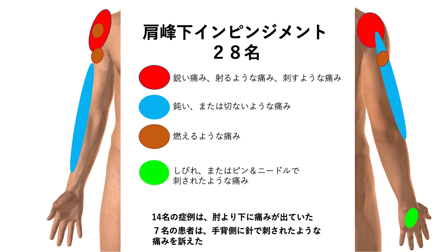 疼痛マッピング（肩関節編）｜こばさん（小林由弥）