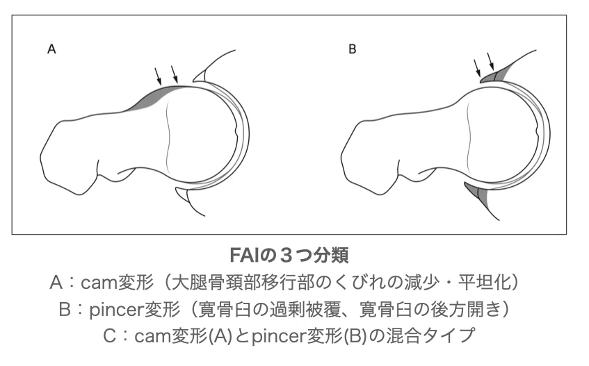 股関節痛の理学療法①2023｜理学療法士による臨床のためのnote
