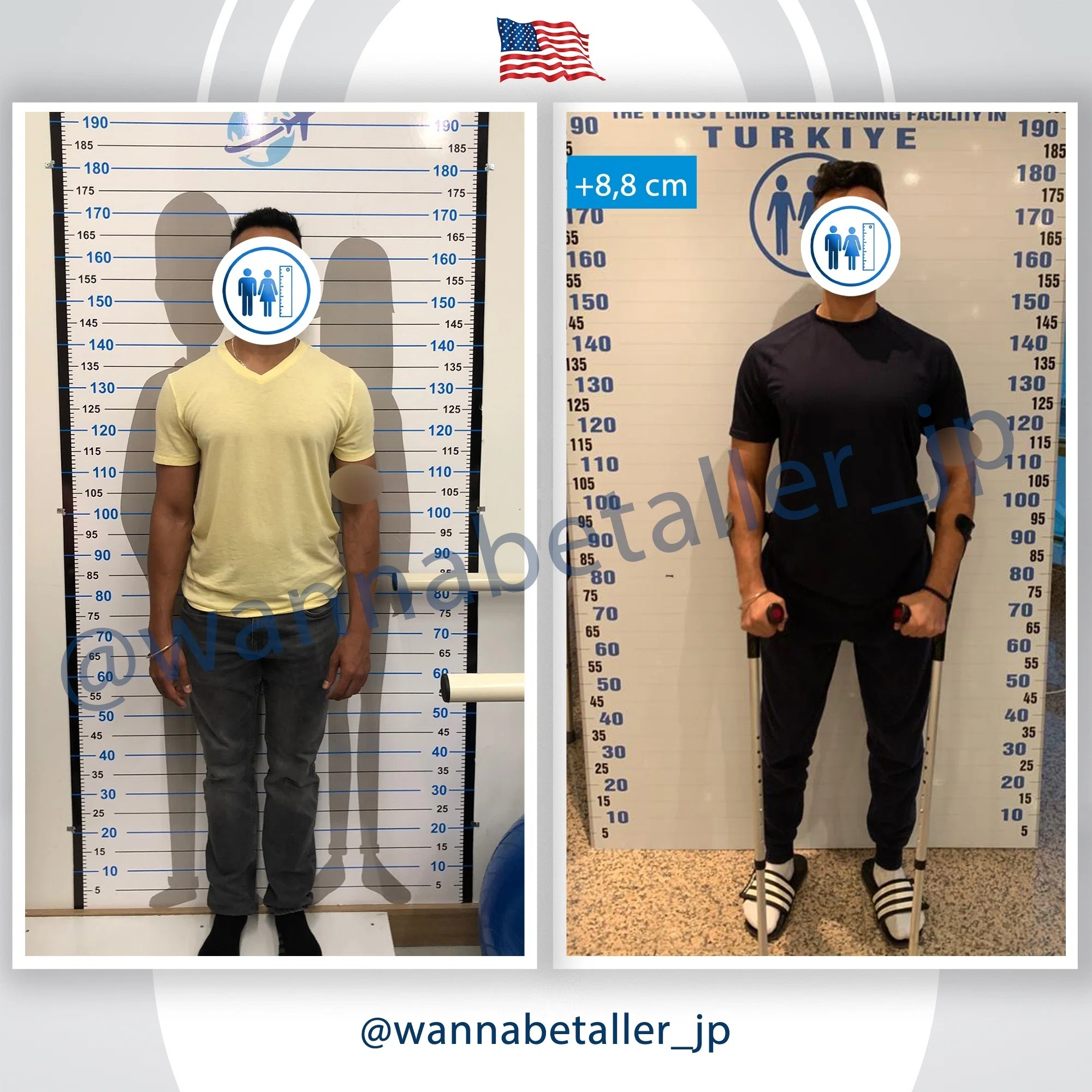 アメリカ人患者の骨延長談｜脚延長クリニック公式｜WannaBeTaller JP