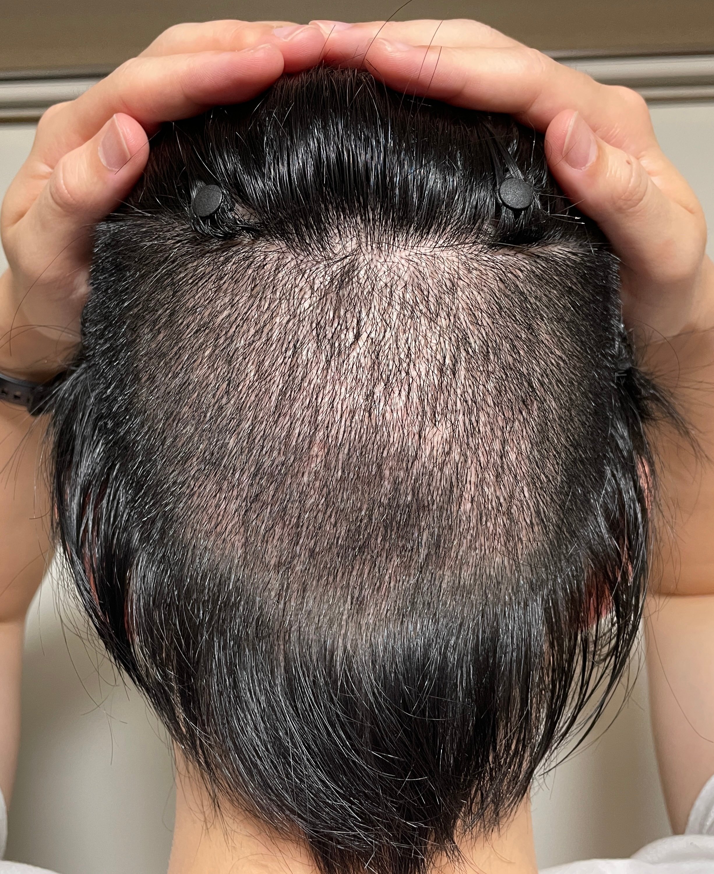 自毛植毛 体験レポート(※2024年8月更新）｜整形社員♂