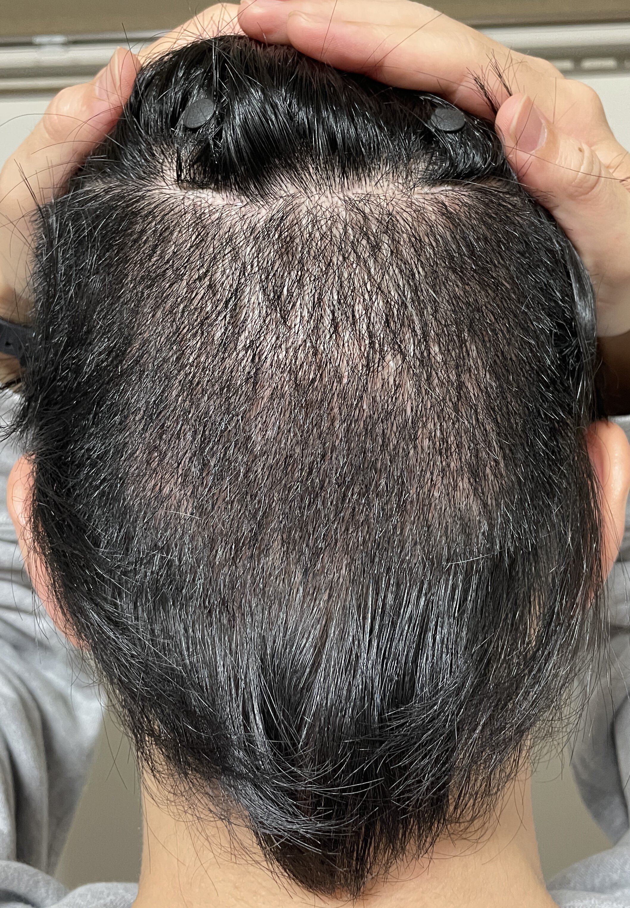 Dr.今川の植毛体験記 専門医が自分の髪で実践したドキュメント 最先端