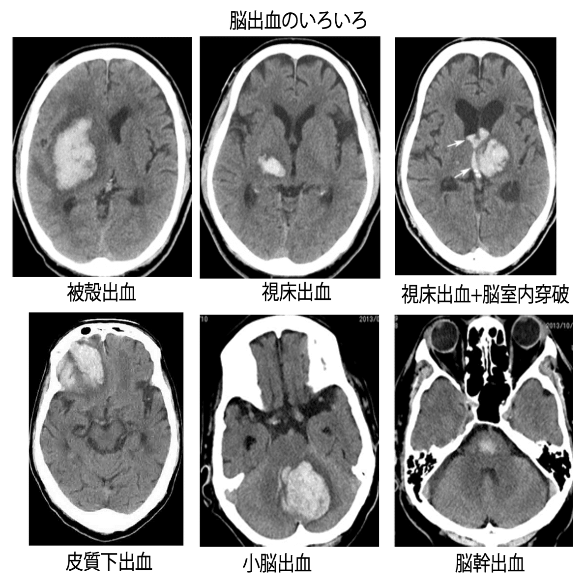 第58回理学療法士国家試験 午後76-80の解説｜Sixty_valleyのページ