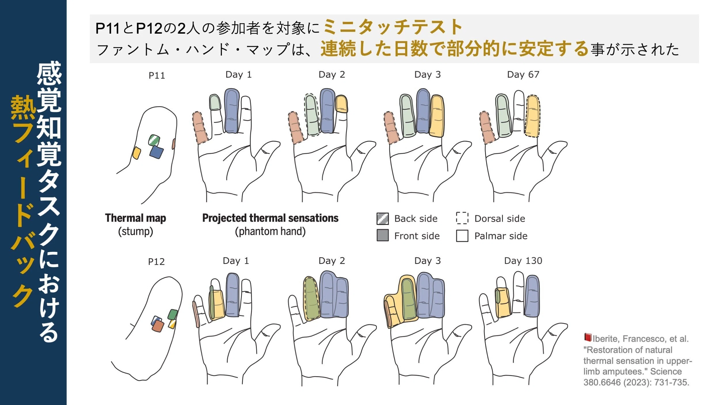 温度を感知する”義手開発の第一歩｜Super Human | 理学療法士／保健学
