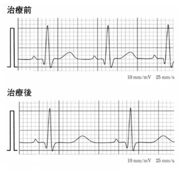理学療法士国家試験対策 循環器・内部障害難問 57回午後11 QT延長を